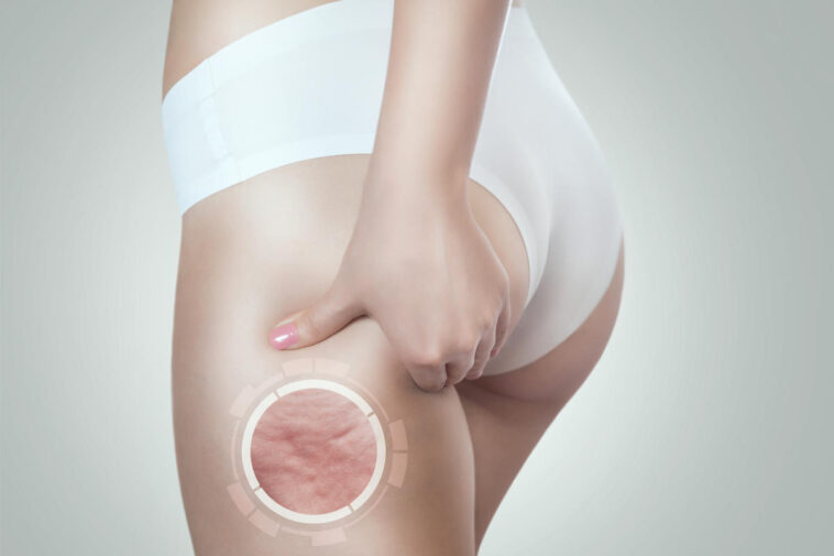 Celulitis: lo que no te dicen sobre los tratamientos que prometen eliminarla por completo