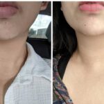 Relleno de Cuello y Botox de Cuello: Todo lo que Necesitas Saber
