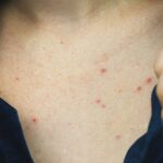 Lo que necesita saber sobre el acne en el pecho