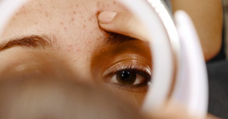 todo lo que necesitas saber sobre el acné en la frente