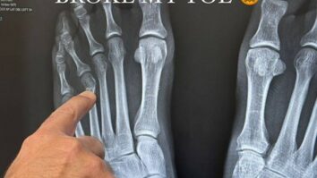 Travis Barker sufre fractura en un dedo del pie