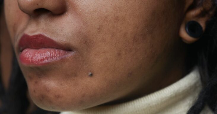¿luchando con el acné en la barbilla? así es como se trata